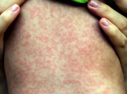 measles