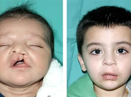 cleft