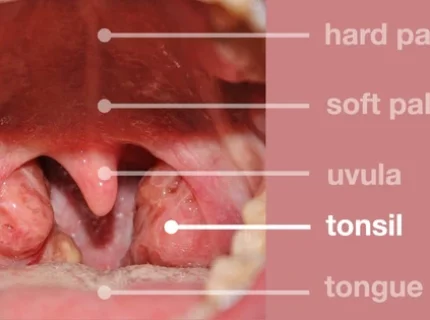 tonsil