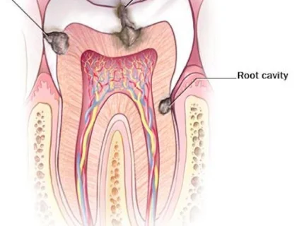 cavity