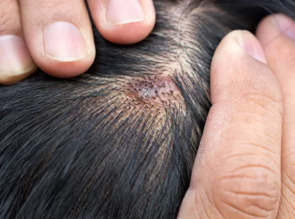 scalp